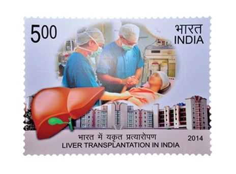 Picture - Liver Transplant